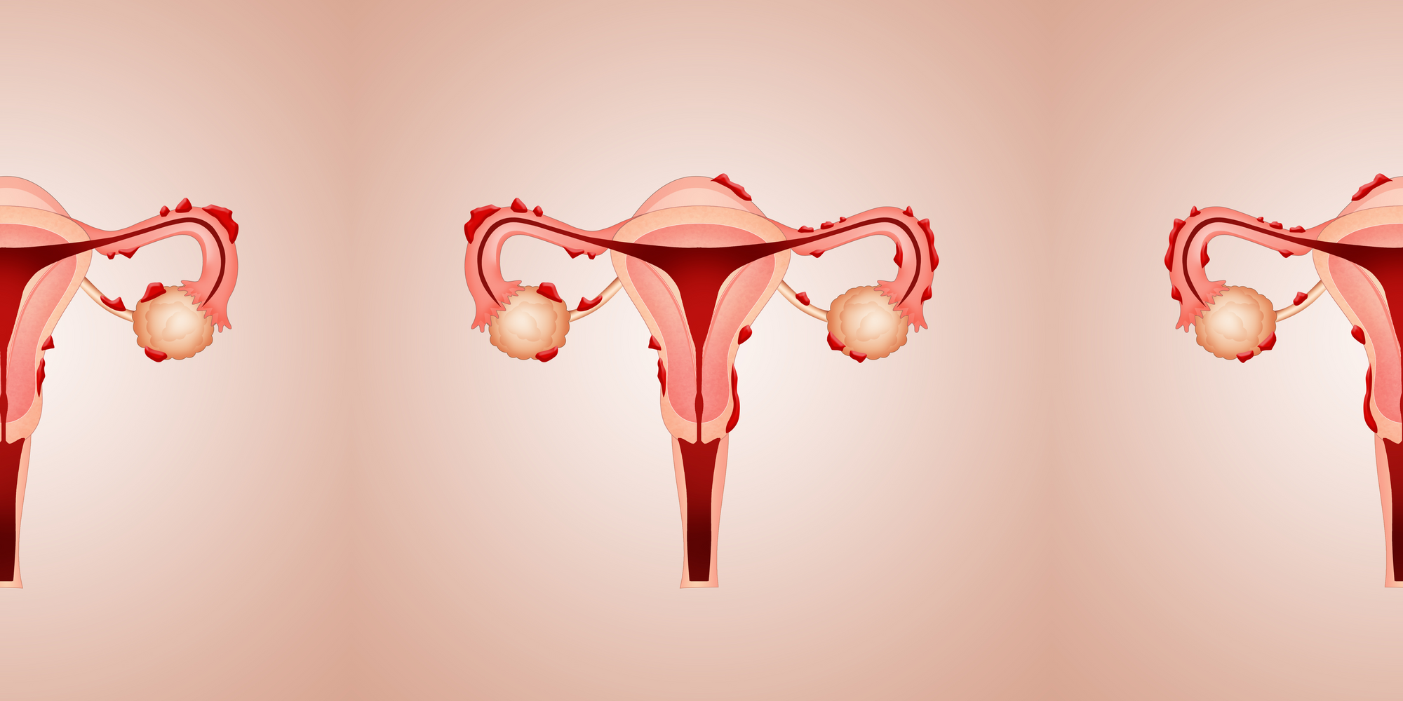 Endometriosis – is there consensus on a role for the gut microbiome?