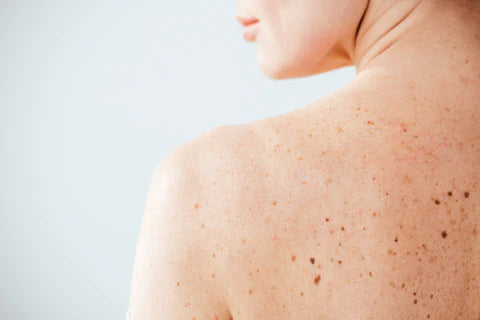The gut microbiome in skin health